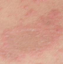 慢性湿疹症状表现