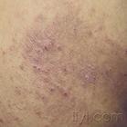 脱溢性皮炎的危害治疗有哪些呢?