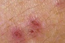 ҩ����Ƥ�׵�����ԭ��