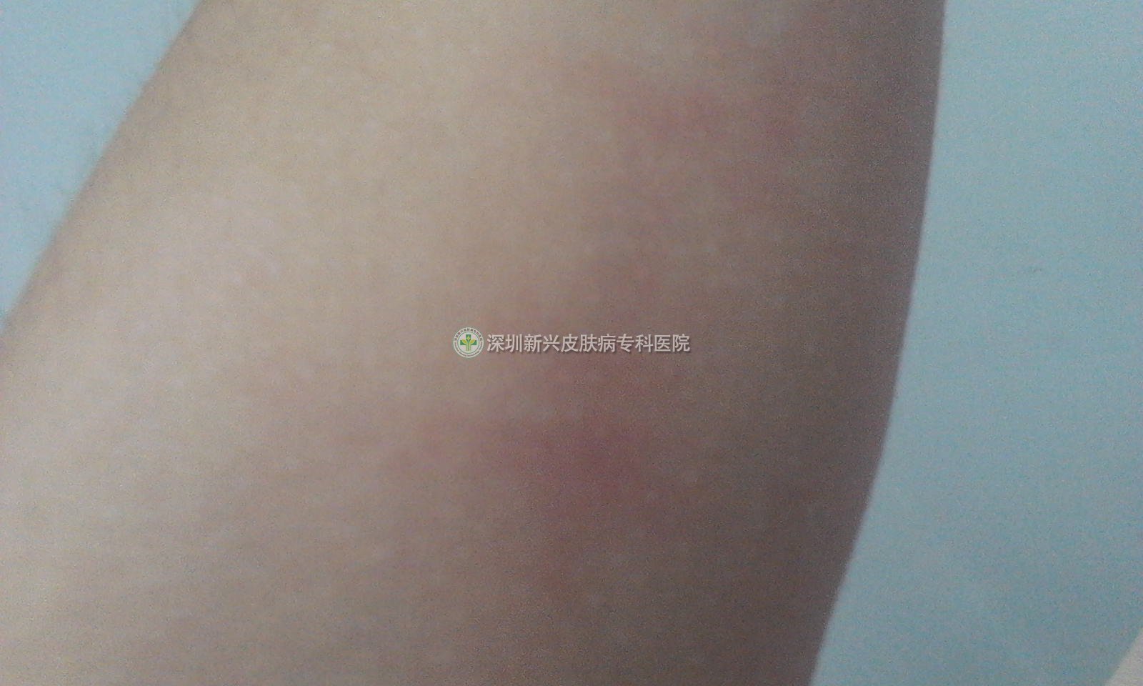 ������������Ƥ�׵Ĳ�����