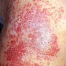 �Ӵ���Ƥ�״�Ⱦ��