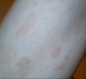 �Ӵ���Ƥ�׵�֢״����