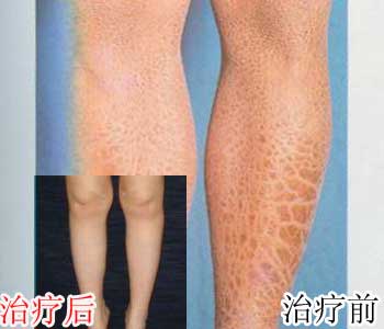 新兴医院帮她摆脱16年“鱼儿身”