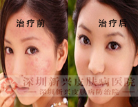 酒店服务人员患上牛皮癣被辞退