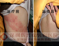CPC牛皮癣整体康复疗法攻克多年牛皮癣