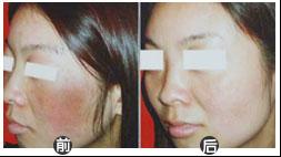 告别四年的皮炎,迎接2012的不痒五一