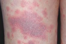 �Ӵ���Ƥ����ʲôҩ��