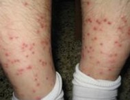 ʲô���׶��Ӵ���Ƥ��