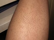 ���۲��ĳ���֢״