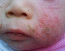 ��ͬ��λʪ��֢״���ֲ�ͬ