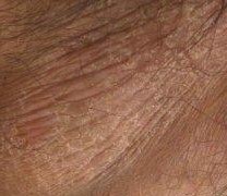 阴囊湿疹的日常预防