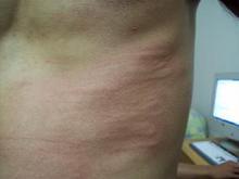 过敏性皮炎发病的最常见症状