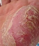 牛皮癣患者要注意哪些并发症