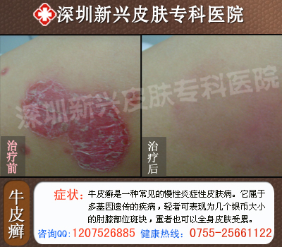 ����ר������ţƤѢҽԺ