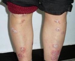 ������ţƤѢ�ļ�ҽԺ��