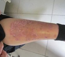 ����ר��ţƤѢҽԺר�ҽ��ܸ�֢״��ʲô