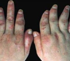 �ؽ�������м����ʲô����֢״