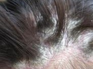 ͷ��ţƤѢ��֢״�ֱ�����Щ����