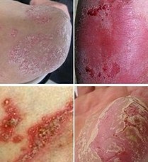 牛皮癣症状类型