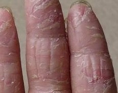 �ֲ�ʪ��֢״