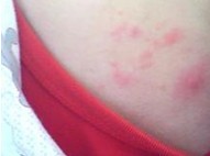 �ֱ�ʪ��֢״