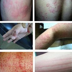 荨麻疹的常见症状