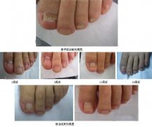 灰指甲的症状表现