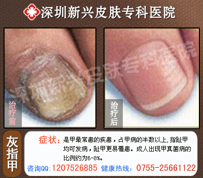 深圳新兴医院灰指甲治疗前后对比