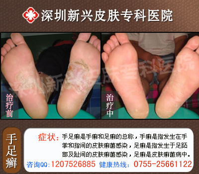 深圳新兴医院手足癣治疗前后对比