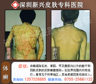 深圳新兴医院体癣治疗前后对比