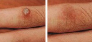 寻常疣治疗对比