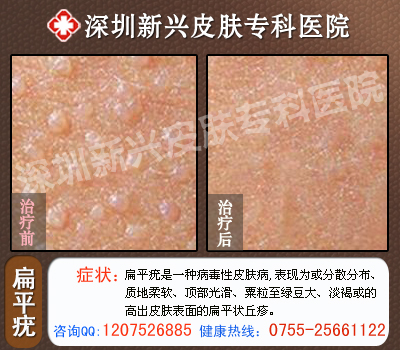 深圳新兴医院扁平疣治疗前后对比