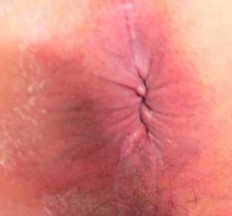 肛门湿疹症状