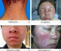皮炎的不同类型