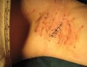 传统疗法治疗狐臭