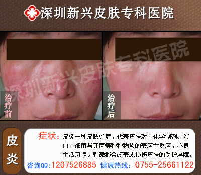 深圳新兴医院皮炎治疗前后对比