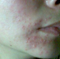 ������Ƥ�׵�֢״ͼ