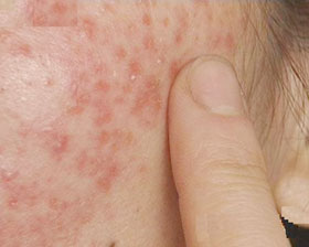 ������Ƥ��֢״ͼƬ